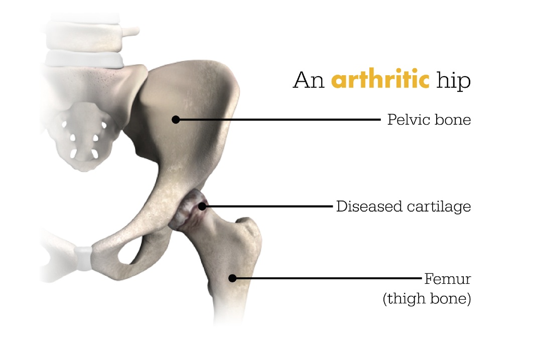 An arthritic hip