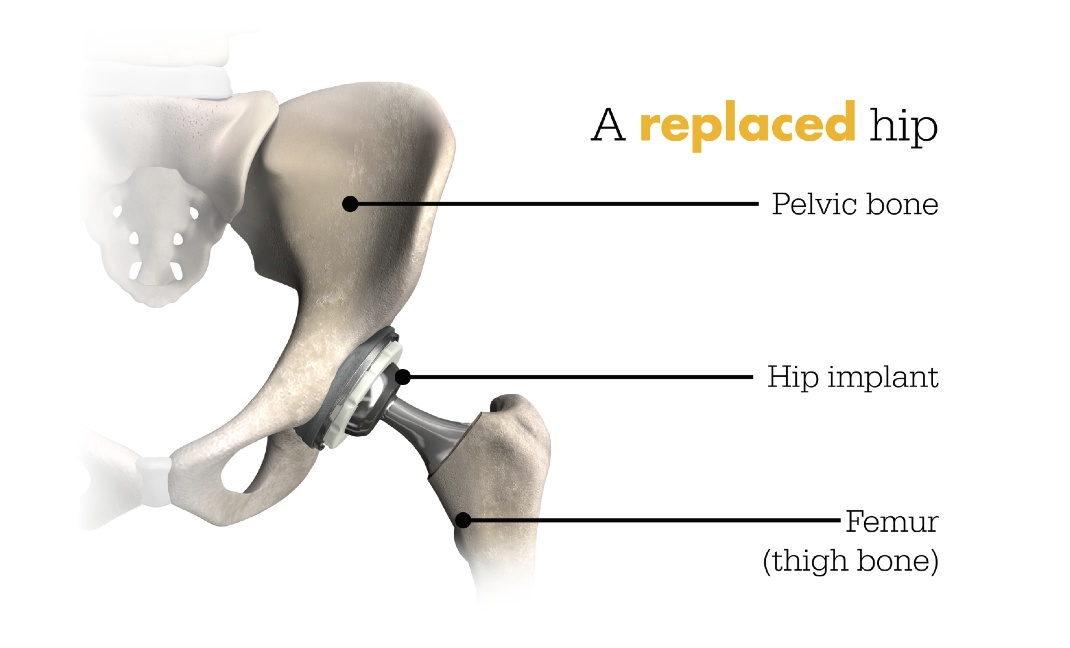 A replaced hip