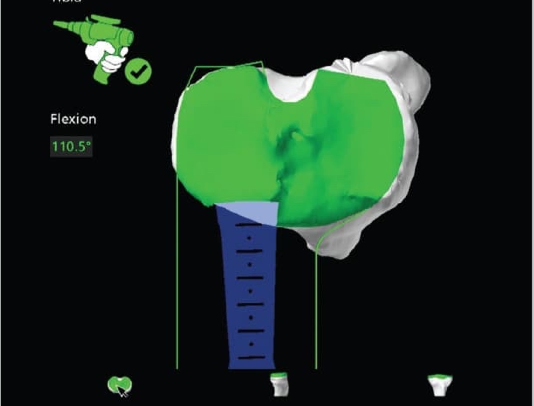 Mako Total Knee Replacement