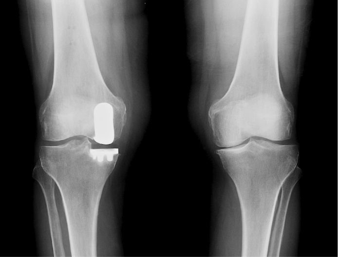 Partial Knee - After Surgery