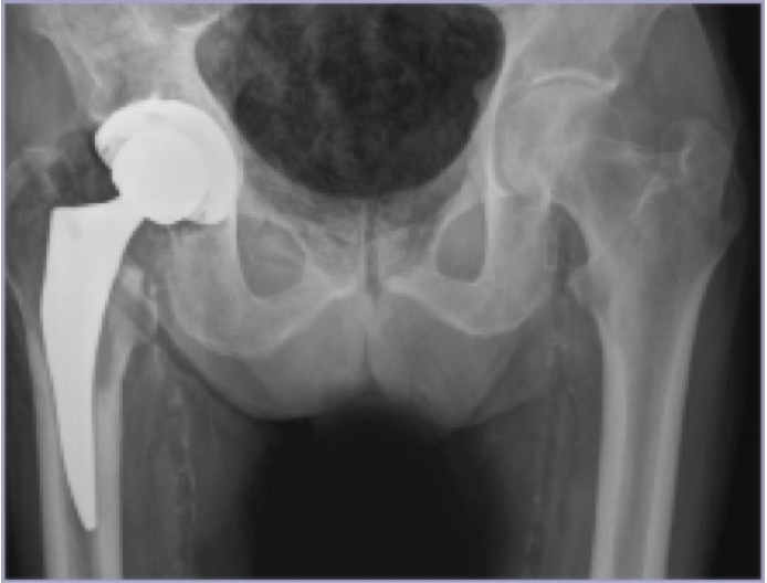 Total Hip - After Surgery