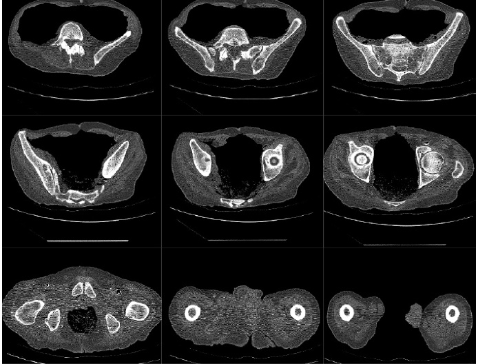 Total Hip - Before Surgery