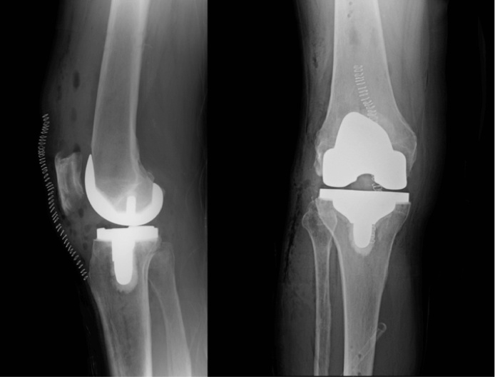 Total Knee - After Surgery