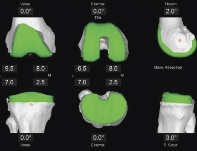 Total Knee - In the Operating Room