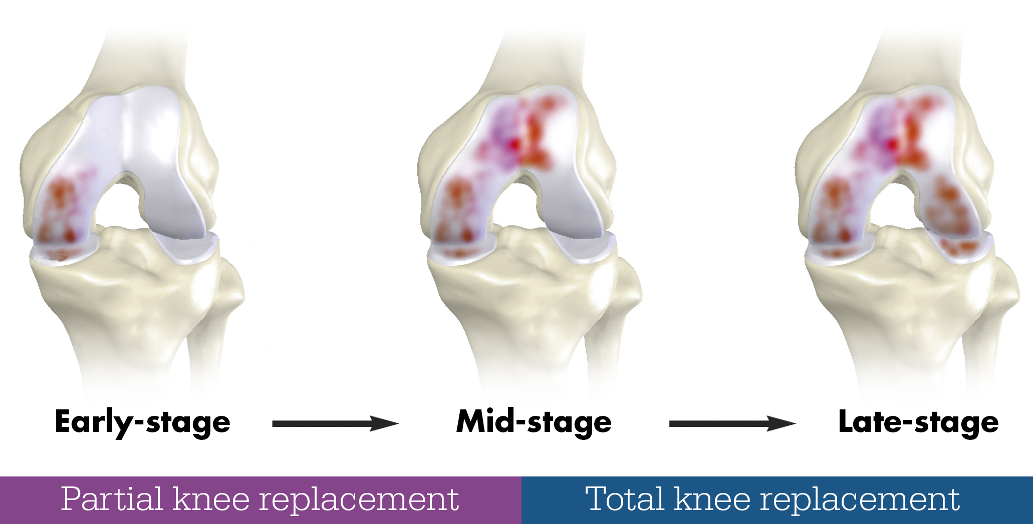 Partial Knee vs Total Knee Replacementg
