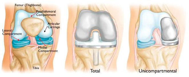 Partial Knee 