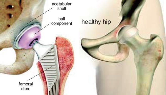 total hip replacement