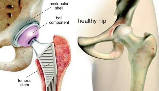 https://www.muskegonsurgerycenter.com/uploads/images/total-hip-replacement.jpg