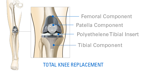 Total Knee 